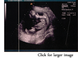 Liam's sonogram, in which he is giving a thumbs-up sign